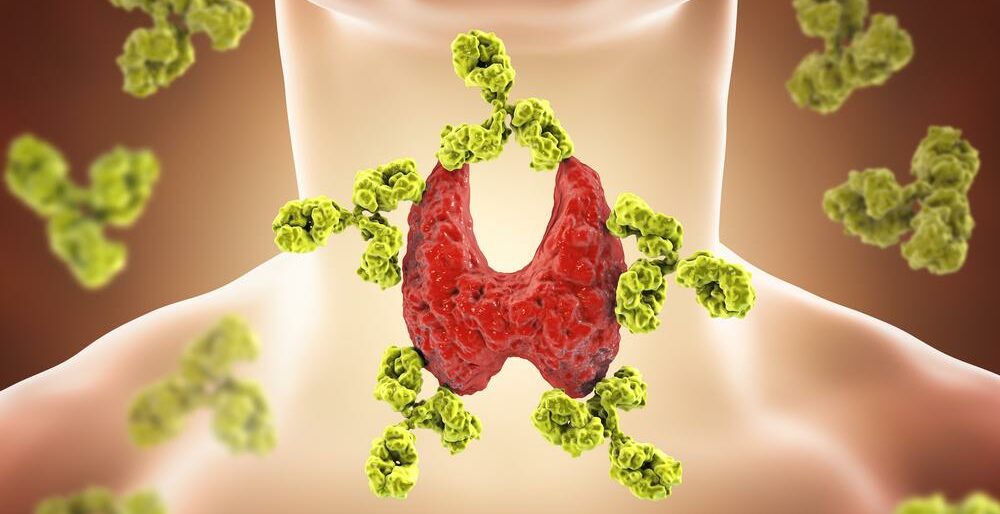 All About Hashimoto’s Thyroiditis